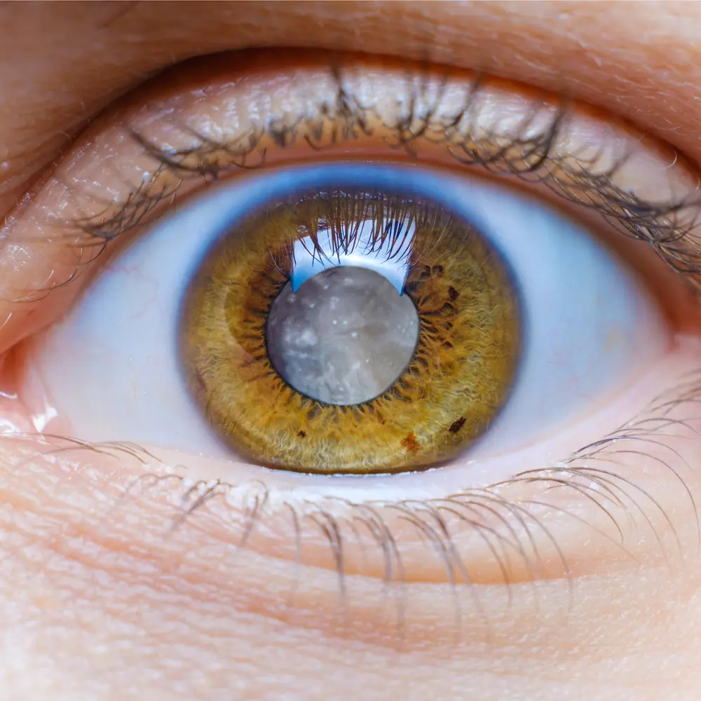 Cataracts