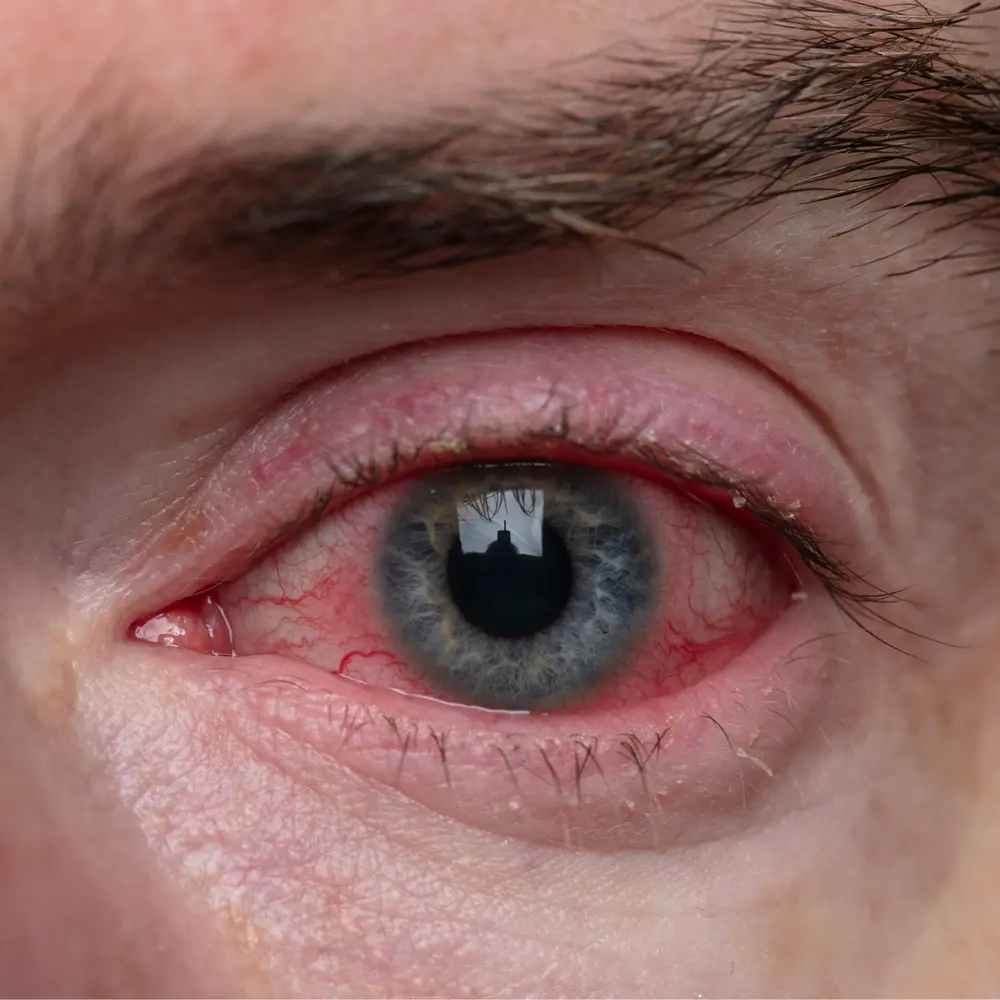 Eye Infections or Inflammation