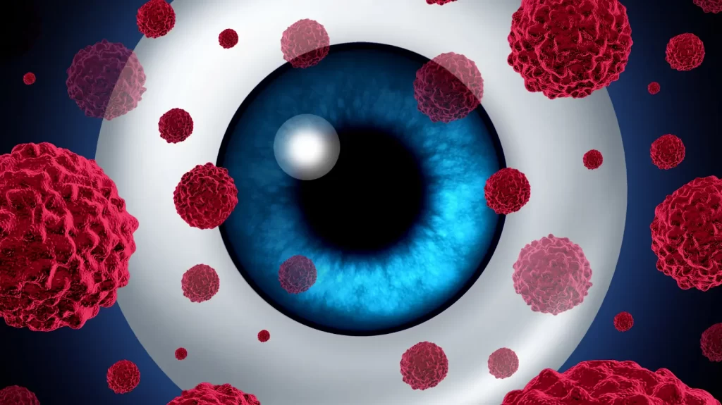 What Is Eye Cancer