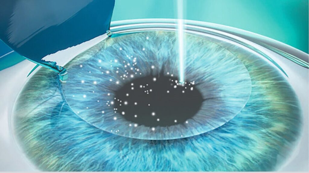 Post-Laser Refractive Surgery Care Complete Guide for a Safe Recovery