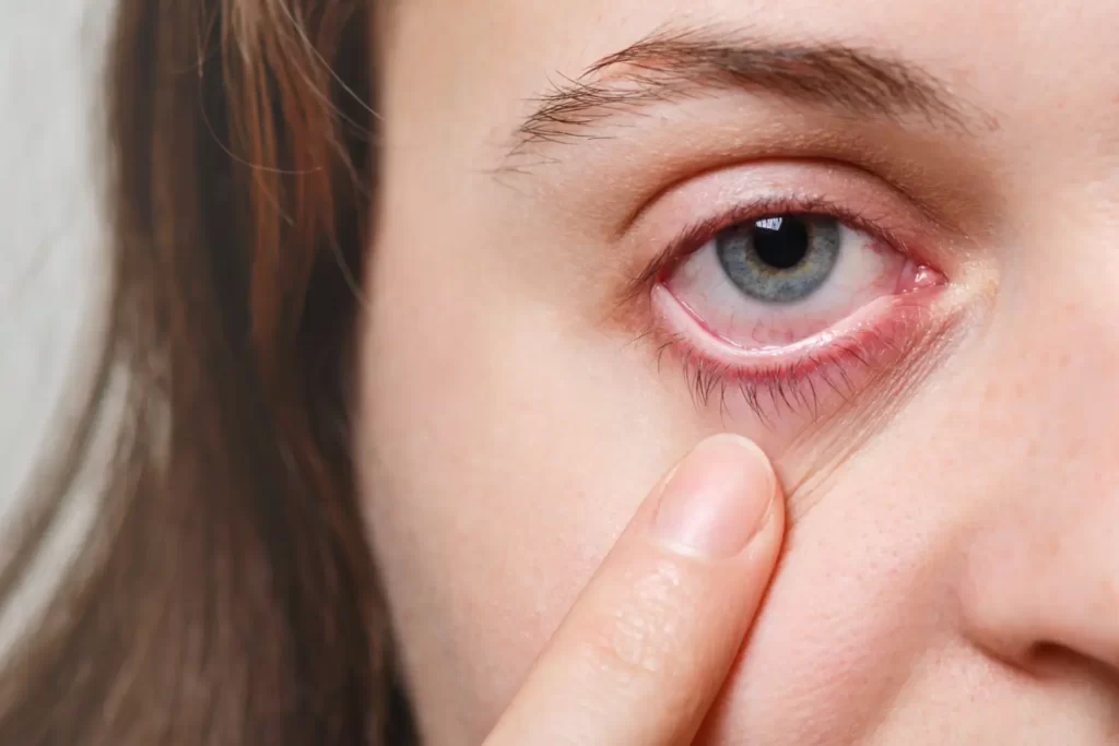 Understanding the Causes of Red Eyes